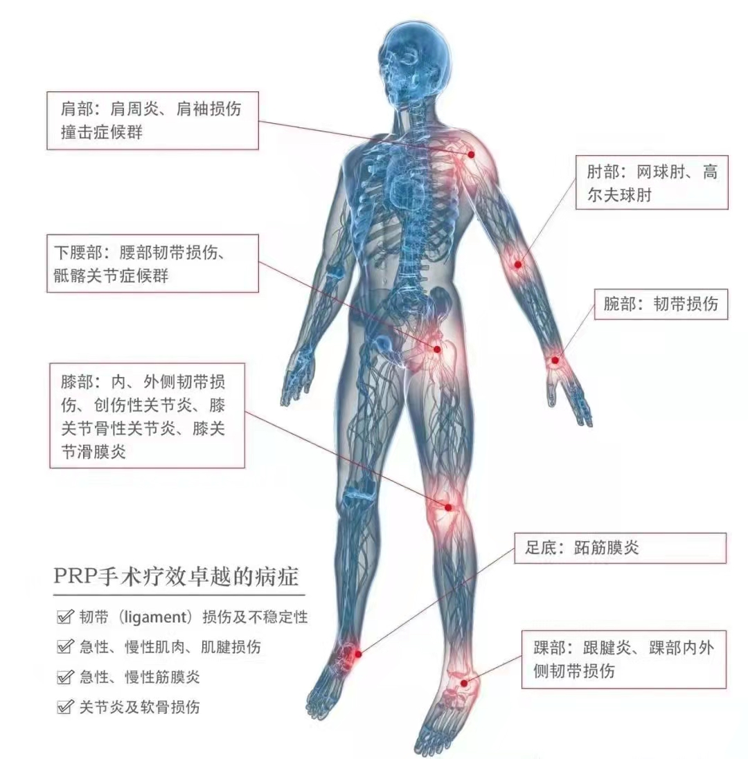 【新技术】骨关节疾病患者的福音！新医大七附院开展PRP（富血小板血浆）治疗