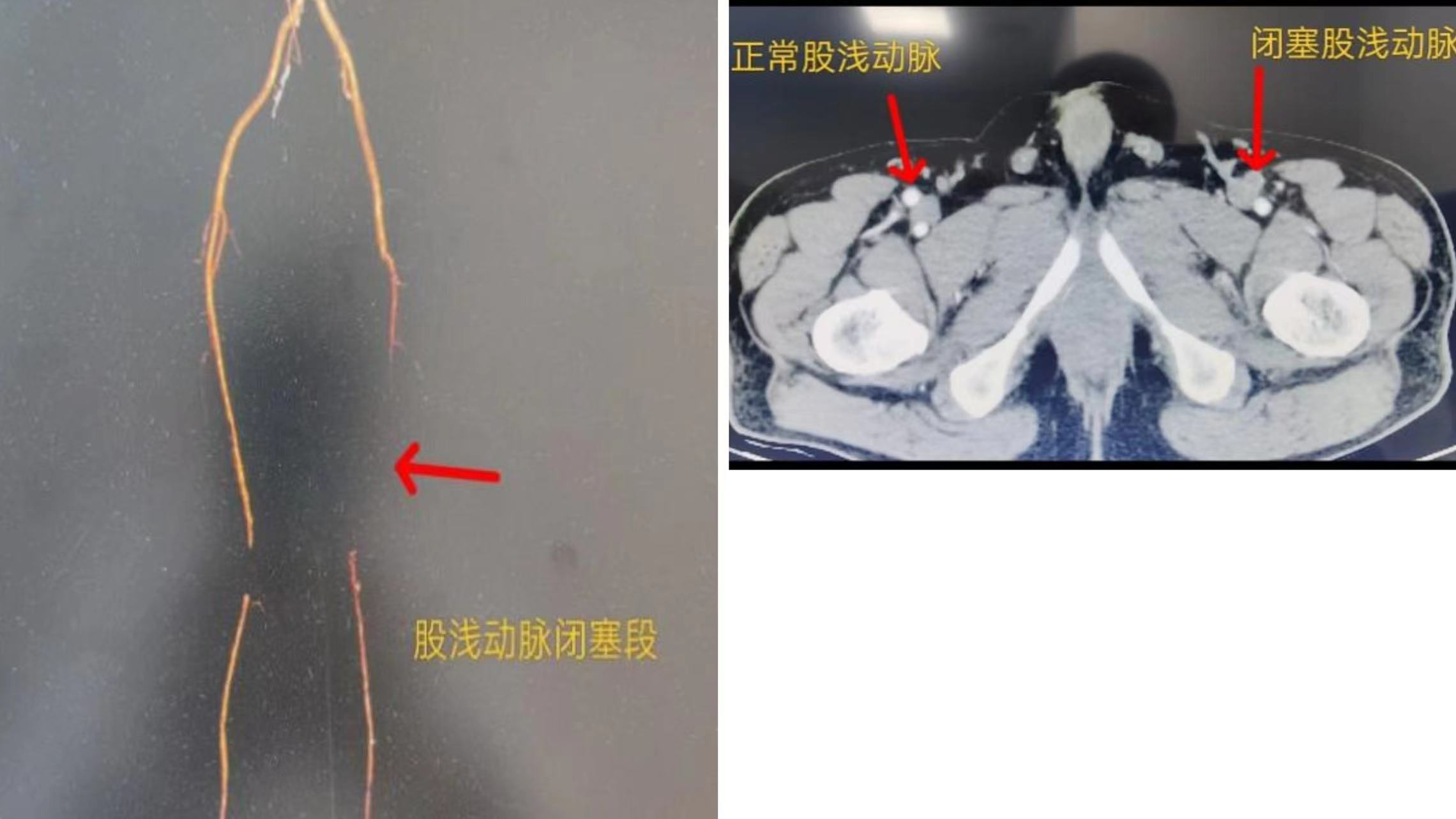 知“足”方能常乐——我院成功完成首例下肢动脉慢性闭塞开通手术