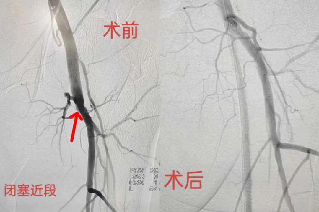 知“足”方能常乐——我院成功完成首例下肢动脉慢性闭塞开通手术