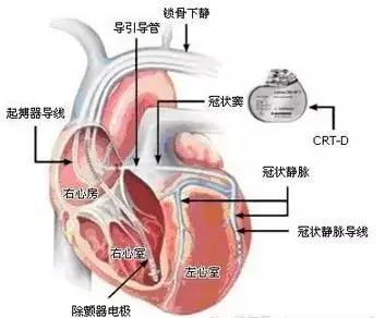 我院成功实施首例心脏再同步除颤器 (CRT-D) 的植入手术